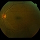 Normal Eye Normal Eye